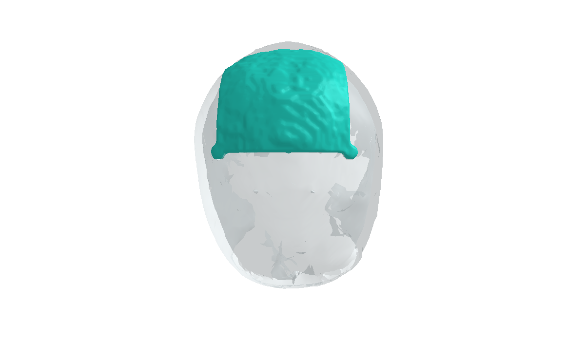 Preview of the CranioSwift demo workbench showing a case in the 3D viewer